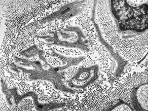 F,31y. | hypertrophic demyelinating neuropathy - n.suralis